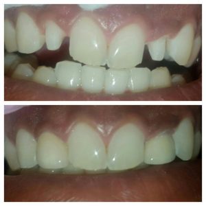 Before and After: Cleveland Murtz